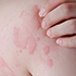 INFORMACJE DERMATOLOGICZNE!